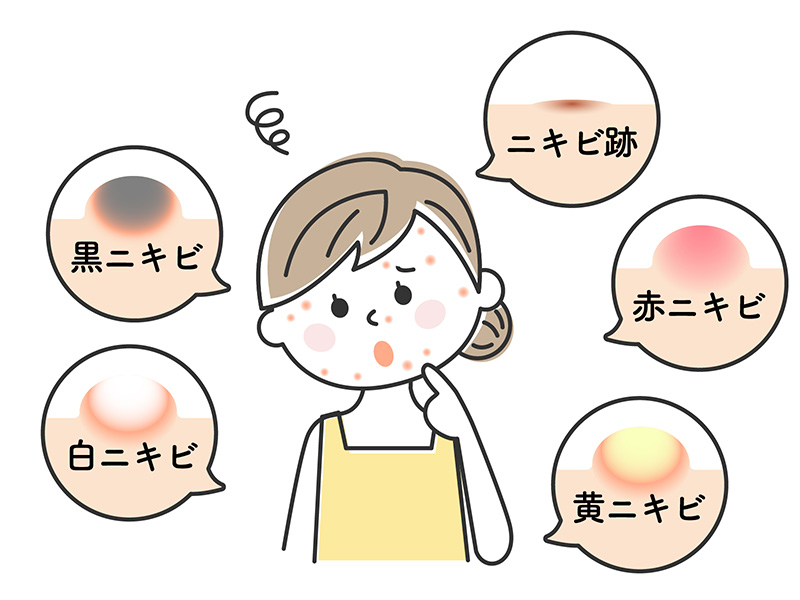 にきびの種類のイラスト