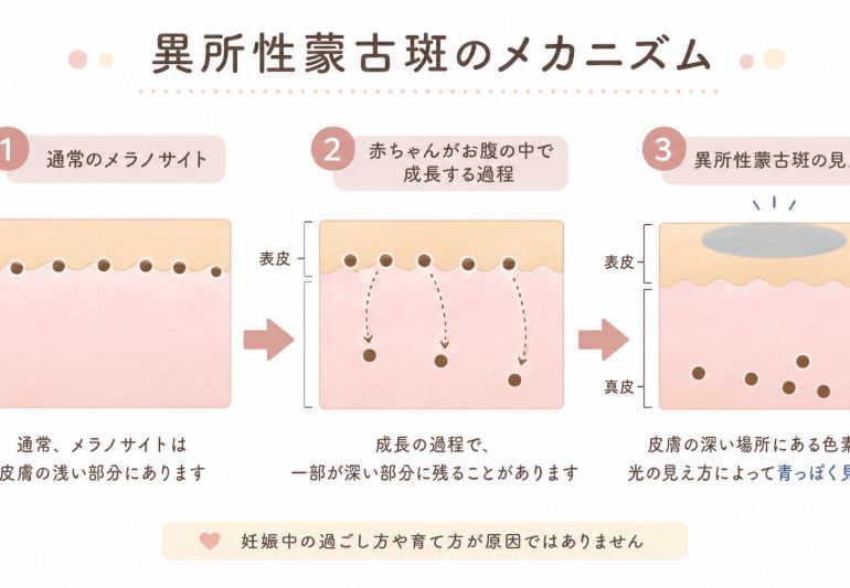 東住吉区・針中野でこどものあざ治療を提供している針中野みずた皮ふ科・形成外科の異所性蒙古斑の説明図